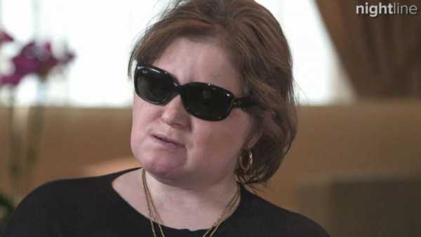 Youngest US face transplant recipient shares story of suicide survival and hope