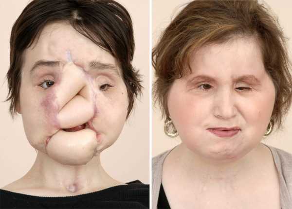 Youngest US face transplant recipient shares story of suicide survival and hope