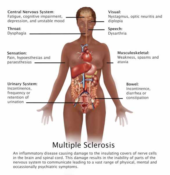 What to know about multiple sclerosis