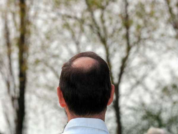 New drug for alopecia shows promise: What you need to know 